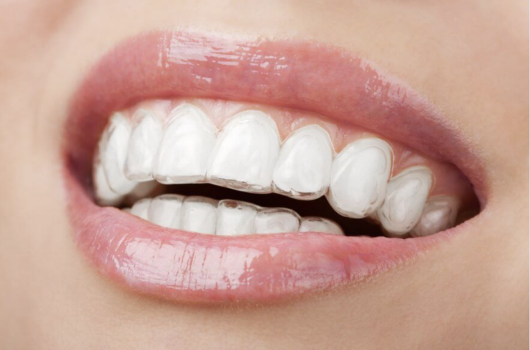 Clear Aligners