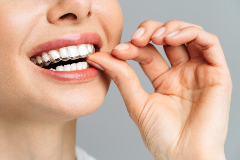 Woman inserting clear aligners into her mouth