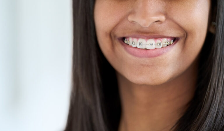 Close Up Of A Smiling Young Woman With Braces