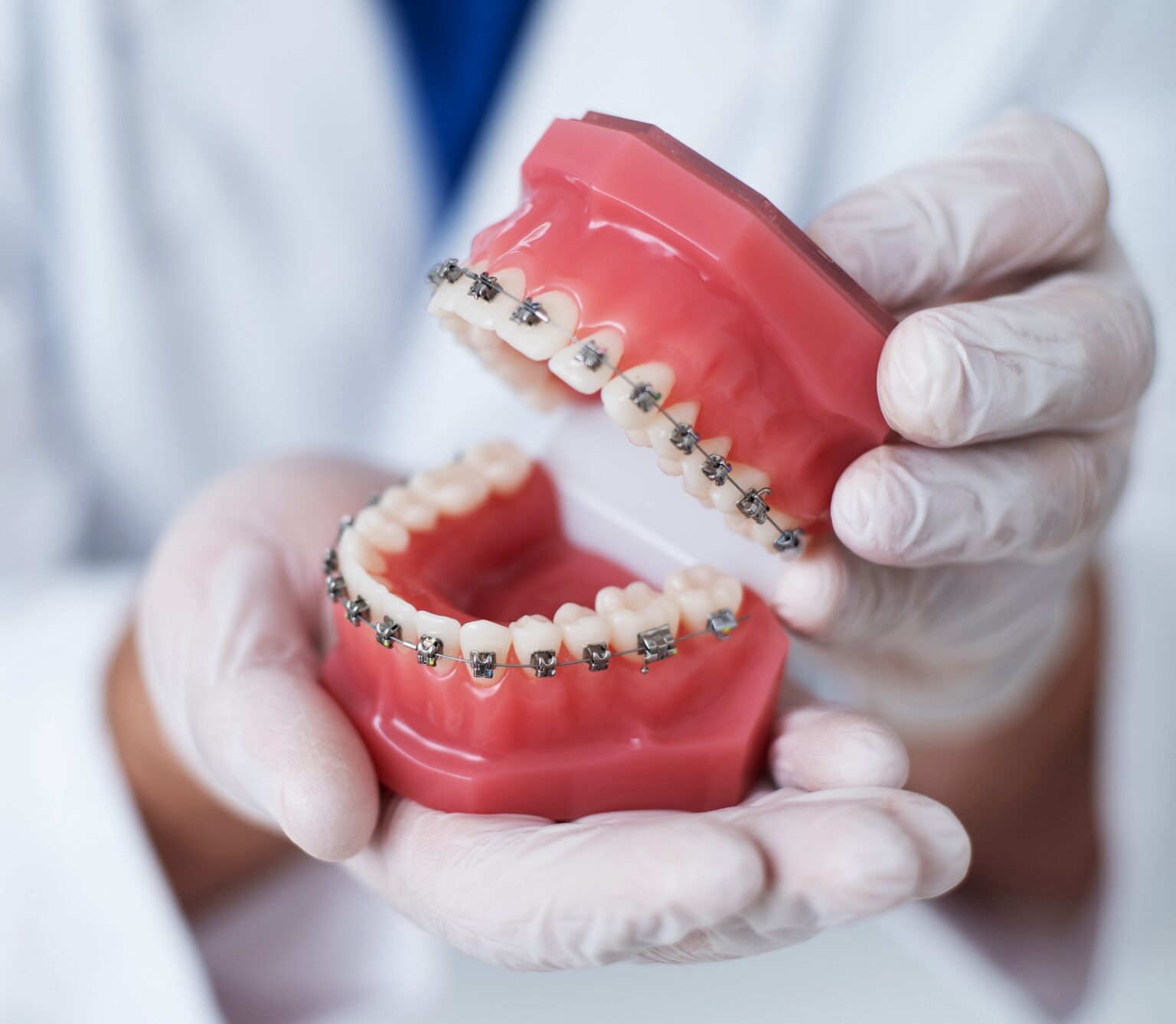 Close up of a dental model with braces being held by an orthodontist with white latex gloves
