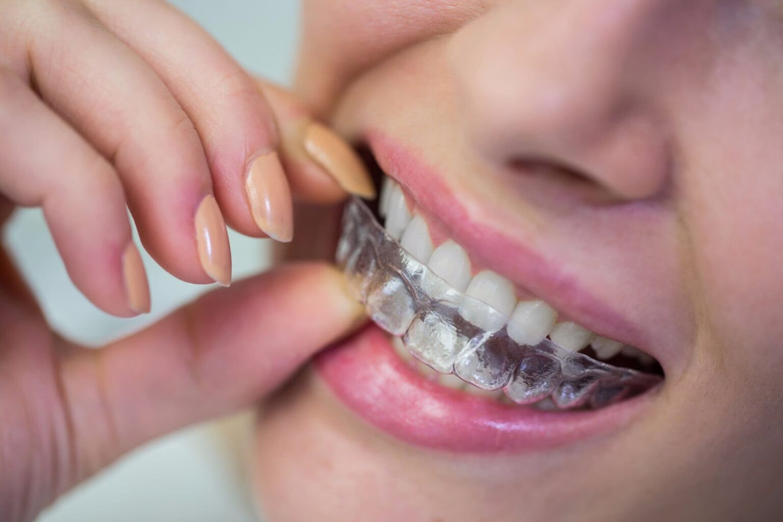 Extreme close up of a woman with pink lip gloss putting her top clear aligner in